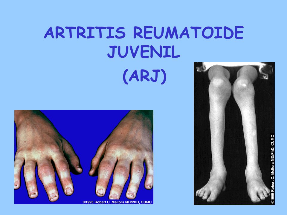 artritis reumatoide juvenil tratamiento en terapia ocupacional